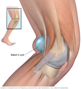 Bakerscyst cause of back of knee pain