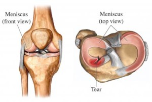Meniscus tear cause of back of knee pain