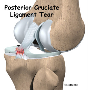 Posterior Cruciate Ligament (PCL) Tear second cause of back of knee pain
